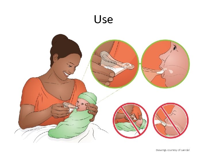 Use Drawings courtesy of Laerdal 