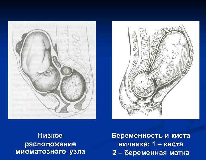 Низкое расположение миоматозного узла Беременность и киста яичника: 1 – киста 2 – беременная