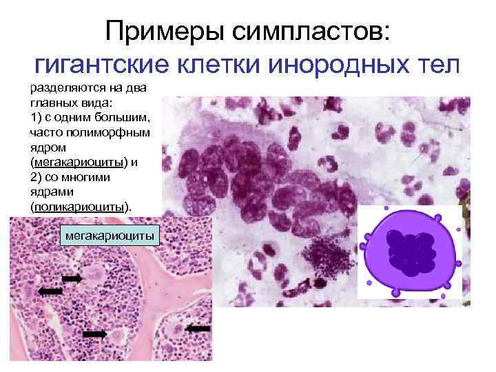 Примеры симпластов: гигантские клетки инородных тел разделяются на два главных вида: 1) с одним