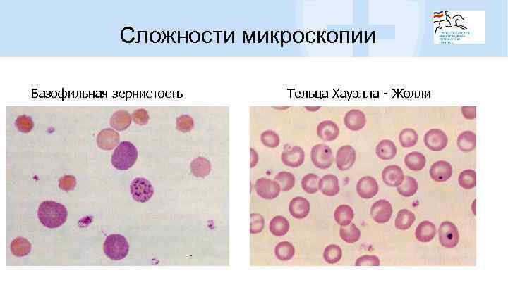 Сложности микроскопии Базофильная зернистость Тельца Хауэлла - Жолли 