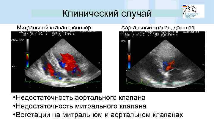 Клинический случай Митральный клапан, допплер Аортальный клапан, допплер • Недостаточность аортального клапана • Недостаточность