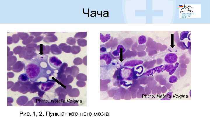 Чача Photo: Natalia Volgina Рис. 1, 2. Пунктат костного мозга Photo: Natalia Volgina 