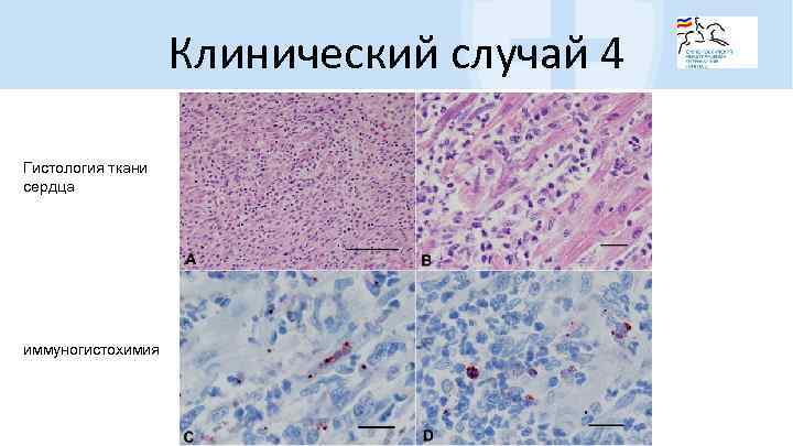 Клинический случай 4 Гистология ткани сердца иммуногистохимия 