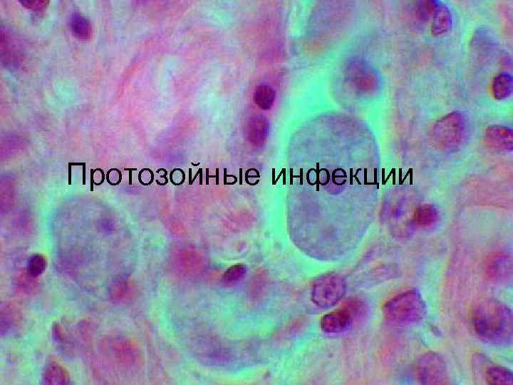 Протозойные инфекции 