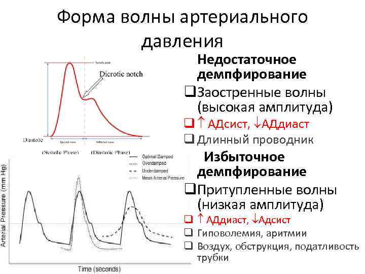 Форма волны артериального давления Недостаточное демпфирование q. Заостренные волны (высокая амплитуда) q АДсист, АДдиаст