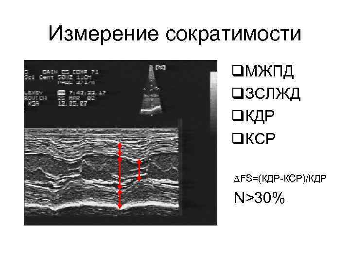 Измерение сократимости q. МЖПД q. ЗСЛЖД q. КДР q. КСР ∆FS=(КДР-КСР)/КДР N>30% 