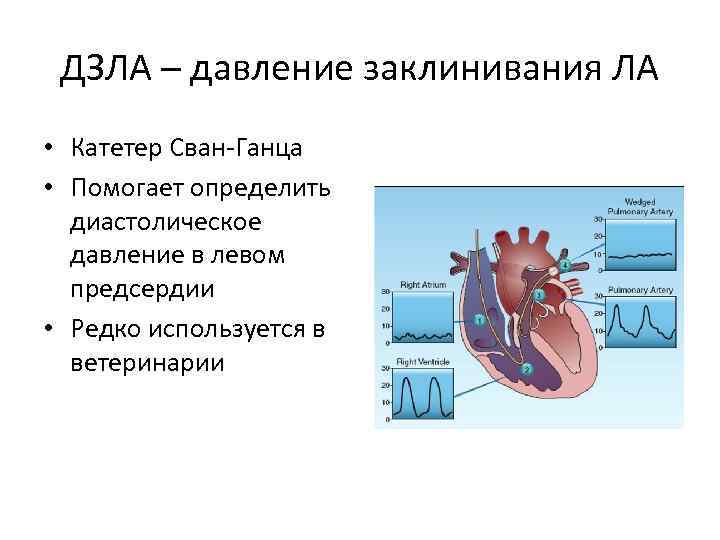 ДЗЛА – давление заклинивания ЛА • Катетер Сван-Ганца • Помогает определить диастолическое давление в