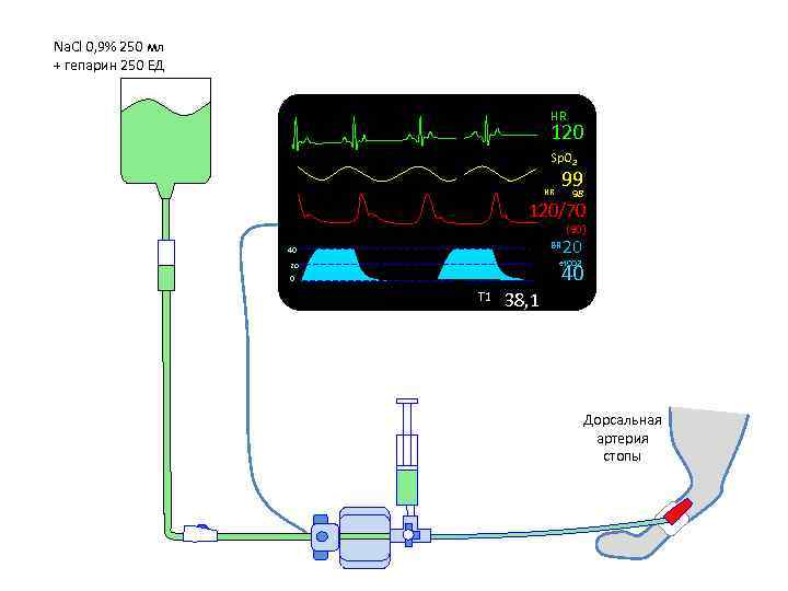 Na. Cl 0, 9% 250 мл + гепарин 250 ЕД HR 120 Sp. O