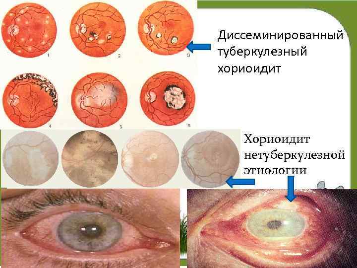 Диссеминированный туберкулезный хориоидит Хориоидит нетуберкулезной этиологии 