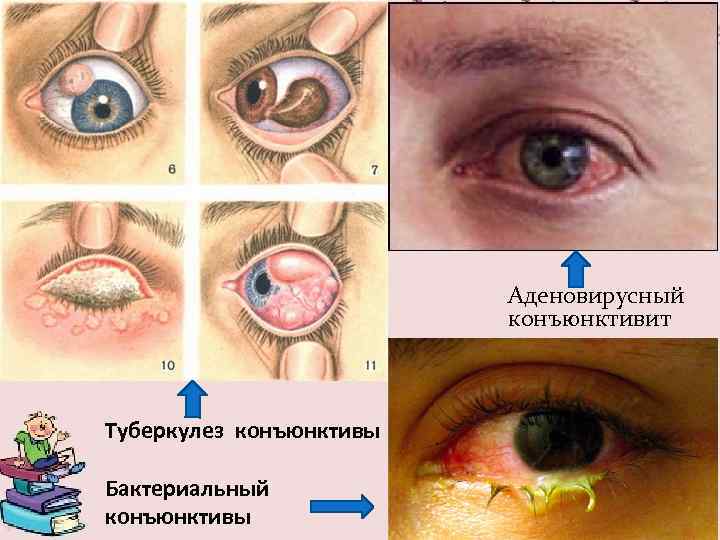 Аденовирусный конъюнктивит Туберкулез конъюнктивы Бактериальный конъюнктивы 