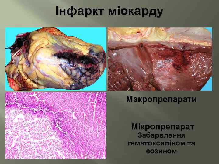 Інфаркт міокарду Макропрепарати Мікропрепарат Забарвлення гематоксиліном та еозином 