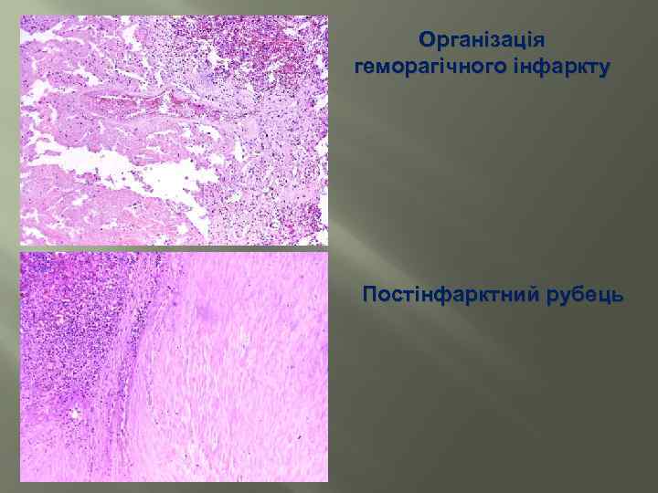 Організація геморагічного інфаркту Постінфарктний рубець 