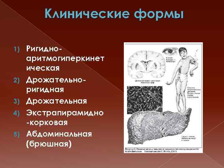 Клинические формы 1) 2) 3) 4) 5) Ригидноаритмогиперкинет ическая Дрожательноригидная Дрожательная Экстрапирамидно -корковая Абдоминальная