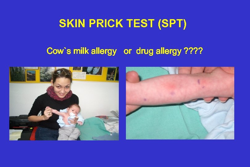 SKIN PRICK TEST (SPT) Cow`s milk allergy or drug allergy ? ? 