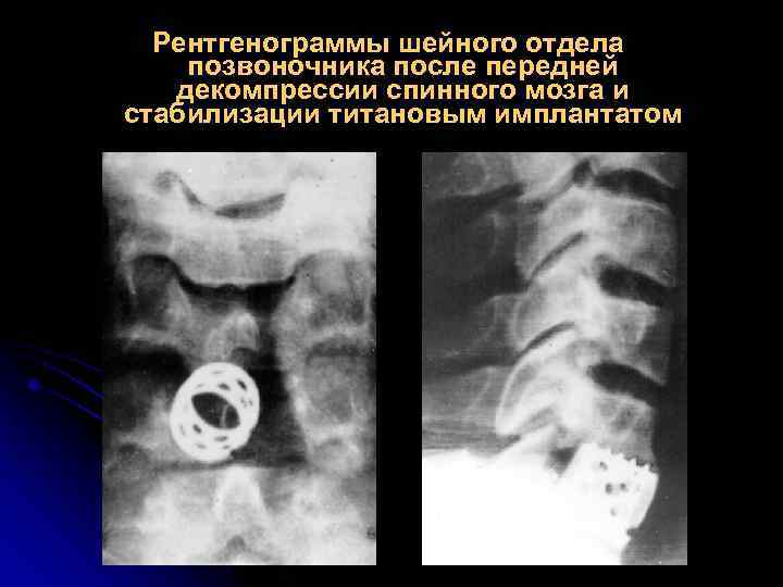 Рентгенограммы шейного отдела позвоночника после передней декомпрессии спинного мозга и стабилизации титановым имплантатом 