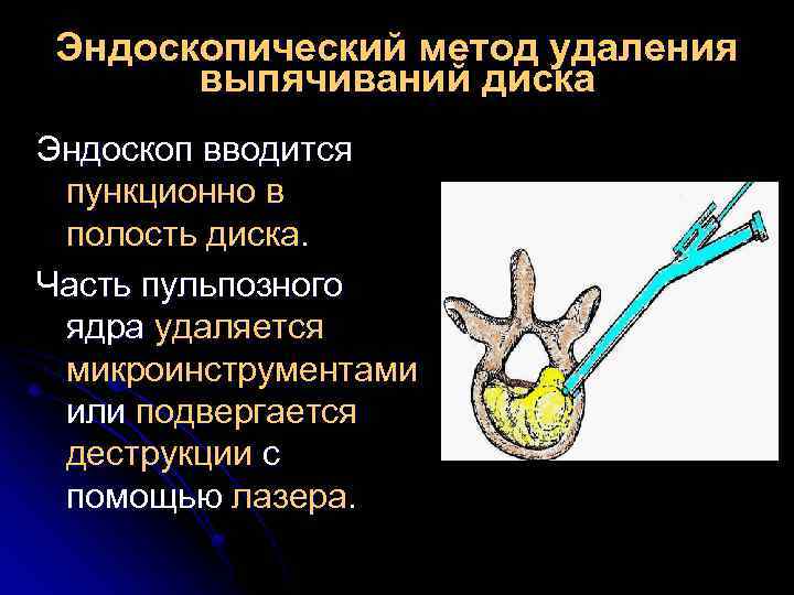 Эндоскопический метод удаления выпячиваний диска Эндоскоп вводится пункционно в полость диска. Часть пульпозного ядра