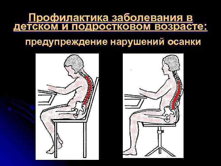 Профилактика заболевания в детском и подростковом возрасте: предупреждение нарушений осанки 