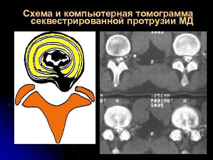 Схема и компьютерная томограмма секвестрированной протрузии МД 