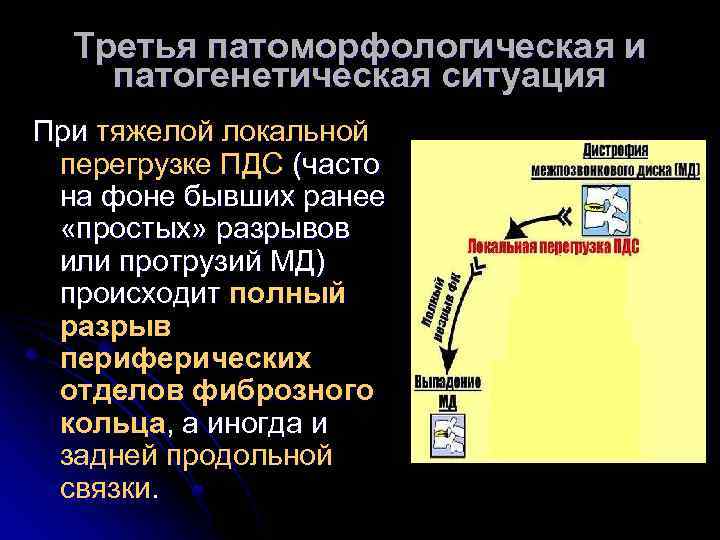Третья патоморфологическая и патогенетическая ситуация При тяжелой локальной перегрузке ПДС (часто на фоне бывших