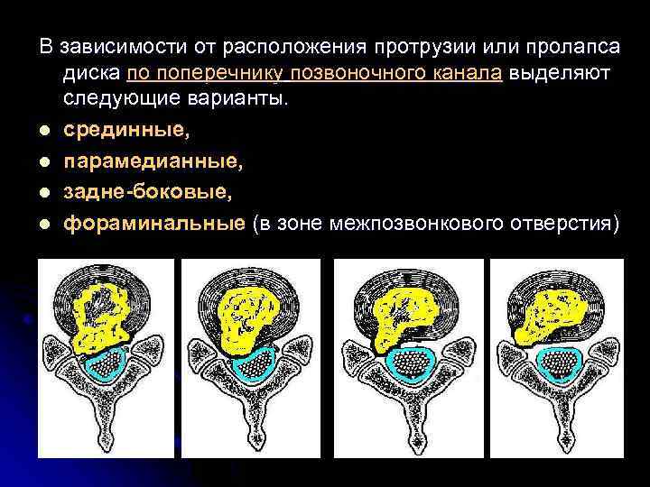 В зависимости от расположения протрузии или пролапса диска по поперечнику позвоночного канала выделяют следующие