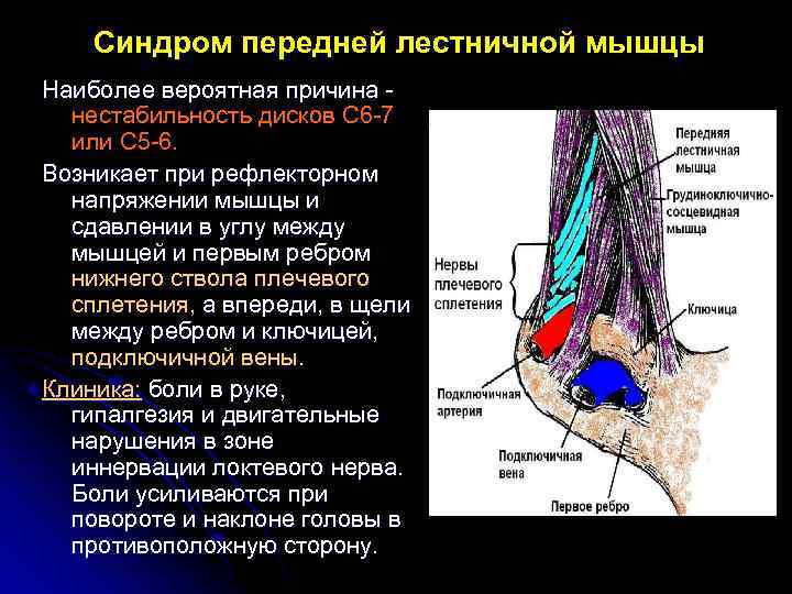 Синдром передней лестничной мышцы Наиболее вероятная причина нестабильность дисков С 6 -7 или С