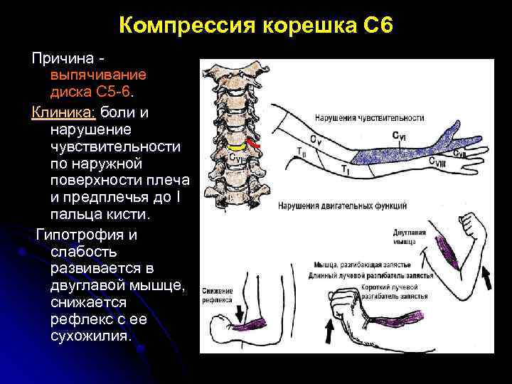 Компрессия корешка С 6 Причина выпячивание диска С 5 -6. Клиника: боли и нарушение