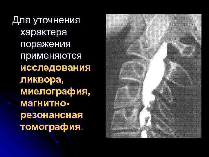 Для уточнения характера поражения применяются исследования ликвора, миелография, магнитнорезонансная томография. 