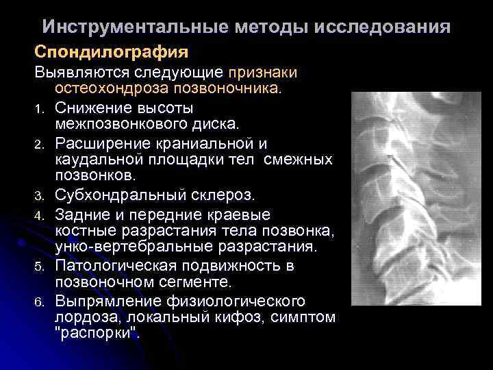 Инструментальные методы исследования Спондилография Выявляются следующие признаки остеохондроза позвоночника. 1. Снижение высоты межпозвонкового диска.