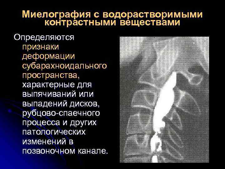 Миелография с водорастворимыми контрастными веществами Определяются признаки деформации субарахноидального пространства, характерные для выпячиваний или