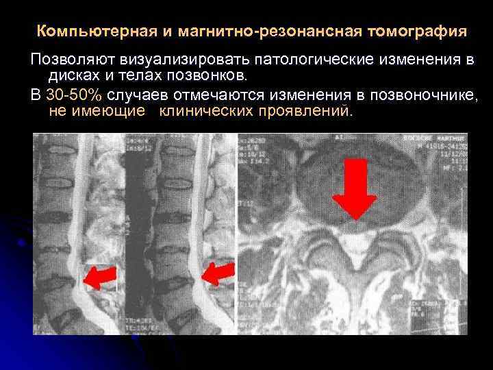 Компьютерная и магнитно-резонансная томография Позволяют визуализировать патологические изменения в дисках и телах позвонков. В