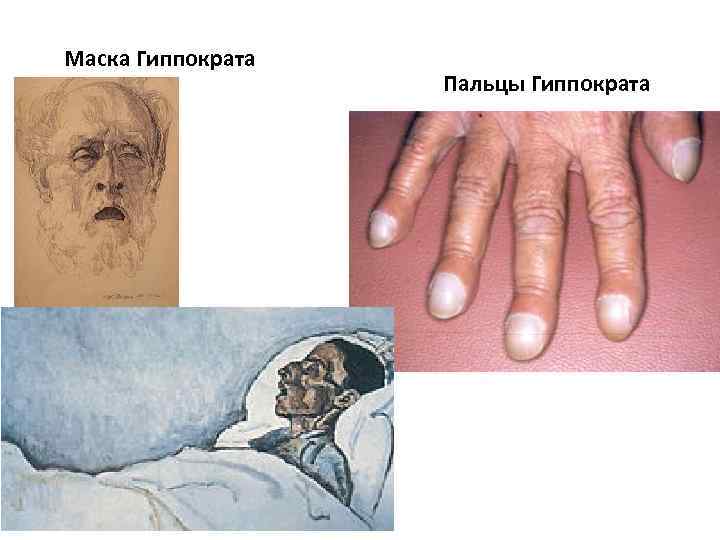 Маска Гиппократа Пальцы Гиппократа 