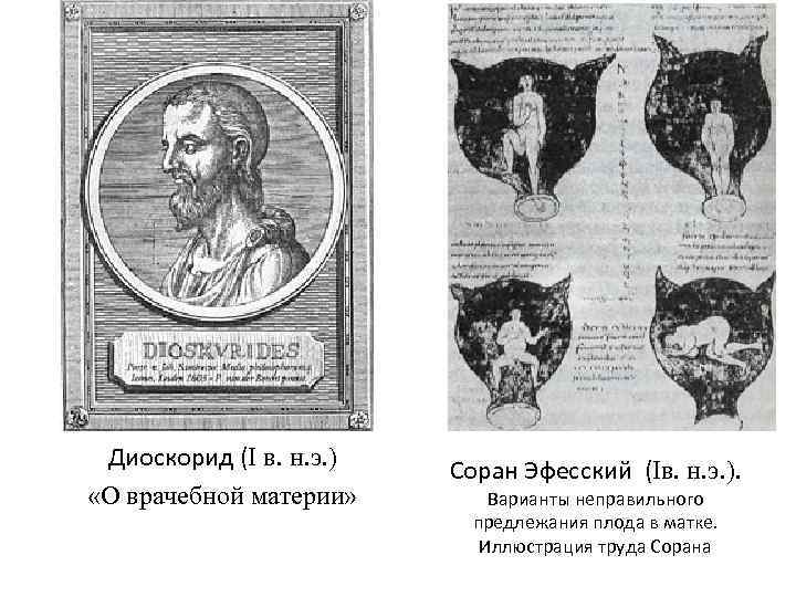  . Диоскорид (I в. н. э. ) «О врачебной материи» Соран Эфесский (Iв.