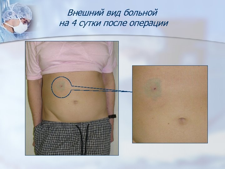 Внешний вид больной на 4 сутки после операции 