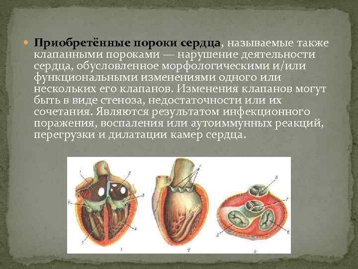 Приобретенные пороки. Приобретенные клапанные пороки сердца. Комбинированный клапанный порок сердца. Комбинированные приобретенные пороки сердца. Приобретенные пороки сердца возникают вследствие.