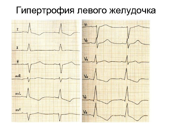 Гипертрофия левого желудочка 