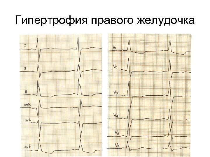 Гипертрофия правого желудочка 