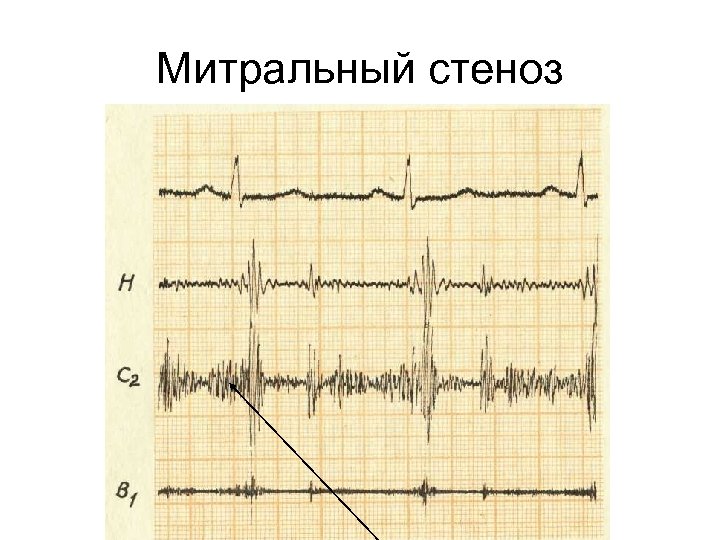 Митральный стеноз 