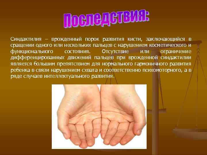 Синдактилия – врожденный порок развития кисти, заключающийся в сращении одного или нескольких пальцев с
