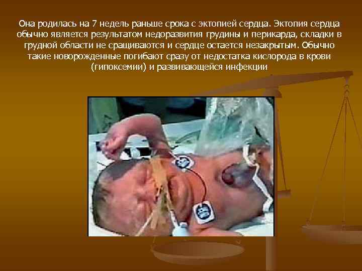Она родилась на 7 недель раньше срока с эктопией сердца. Эктопия сердца обычно является