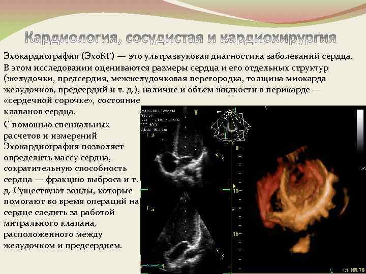 Эхокардиография (Эхо. КГ) — это ультразвуковая диагностика заболеваний сердца. В этом исследовании оцениваются размеры