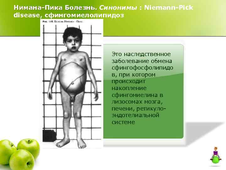 Нимана-Пика Болезнь. Синонимы : Niemann-Pick disease, сфингомиелолипидоз Это наследственное заболевание обмена сфингофосфолипидо в, при