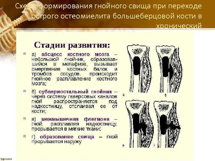Схема формирования гнойного свища при переходе острого остеомиелита большеберцовой кости в хронический 
