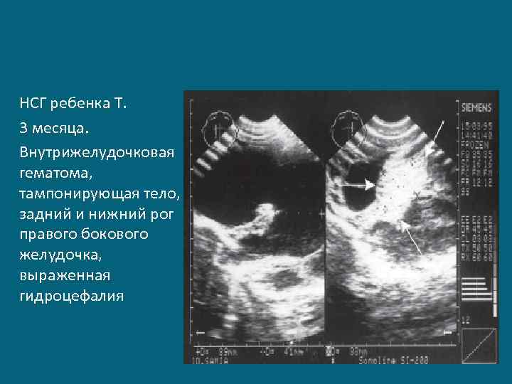 НСГ ребенка Т. 3 месяца. Внутрижелудочковая гематома, тампонирующая тело, задний и нижний рог правого