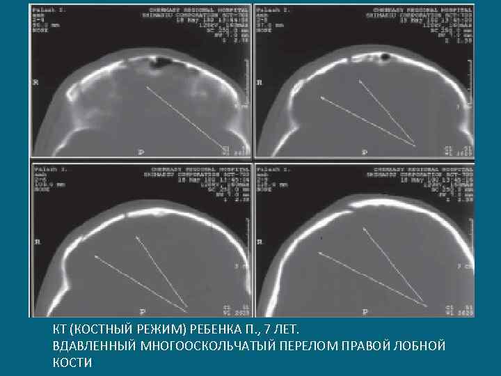 КТ (КОСТНЫЙ РЕЖИМ) РЕБЕНКА П. , 7 ЛЕТ. ВДАВЛЕННЫЙ МНОГООСКОЛЬЧАТЫЙ ПЕРЕЛОМ ПРАВОЙ ЛОБНОЙ КОСТИ