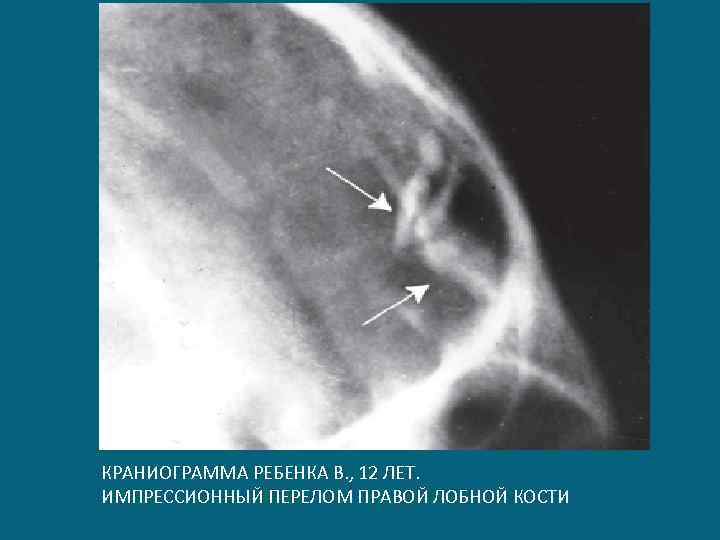 КРАНИОГРАММА РЕБЕНКА В. , 12 ЛЕТ. ИМПРЕССИОННЫЙ ПЕРЕЛОМ ПРАВОЙ ЛОБНОЙ КОСТИ 