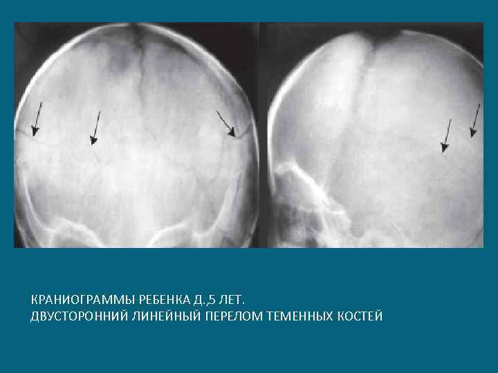 КРАНИОГРАММЫ РЕБЕНКА Д. , 5 ЛЕТ. ДВУСТОРОННИЙ ЛИНЕЙНЫЙ ПЕРЕЛОМ ТЕМЕННЫХ КОСТЕЙ 