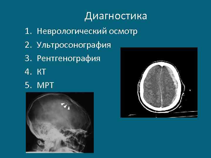 Диагностика 1. 2. 3. 4. 5. Неврологический осмотр Ультросонография Рентгенография КТ МРТ 