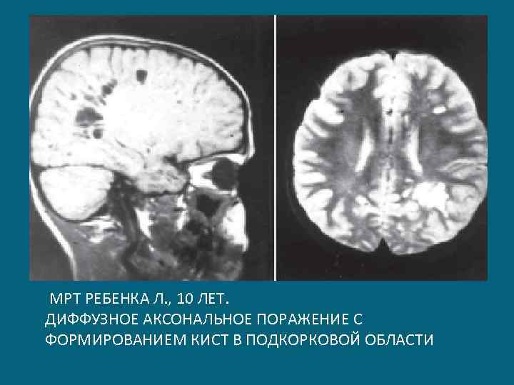  МРТ РЕБЕНКА Л. , 10 ЛЕТ. ДИФФУЗНОЕ АКСОНАЛЬНОЕ ПОРАЖЕНИЕ С ФОРМИРОВАНИЕМ КИСТ В