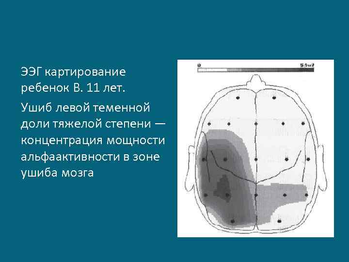 ЭЭГ картирование ребенок В. 11 лет. Ушиб левой теменной доли тяжелой степени — концентрация