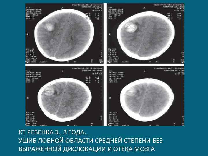 КТ РЕБЕНКА З. , 3 ГОДА. УШИБ ЛОБНОЙ ОБЛАСТИ СРЕДНЕЙ СТЕПЕНИ БЕЗ ВЫРАЖЕННОЙ ДИСЛОКАЦИИ
